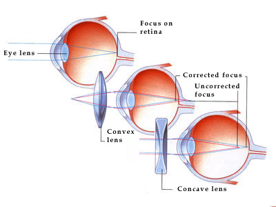Different kinds of lenses are used to correct far-sightedness and near-sightedness.